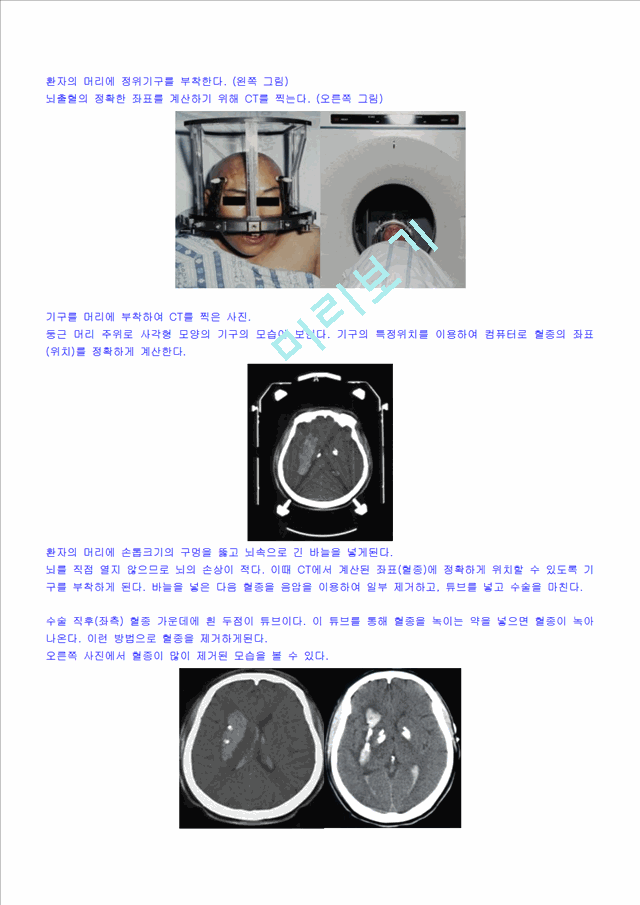 ICH-Intracerebral hemorrhage   (4 )